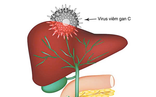 Viêm gan C là bệnh gì mà lại tiềm ẩn nguy cơ đe dọa đến tính mạng