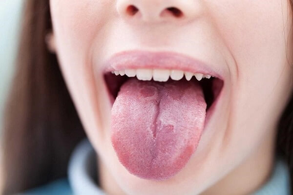 Thiếu vitamin B12 gây bệnh gì: lưỡi bị sưng to và đỏ, mất gai